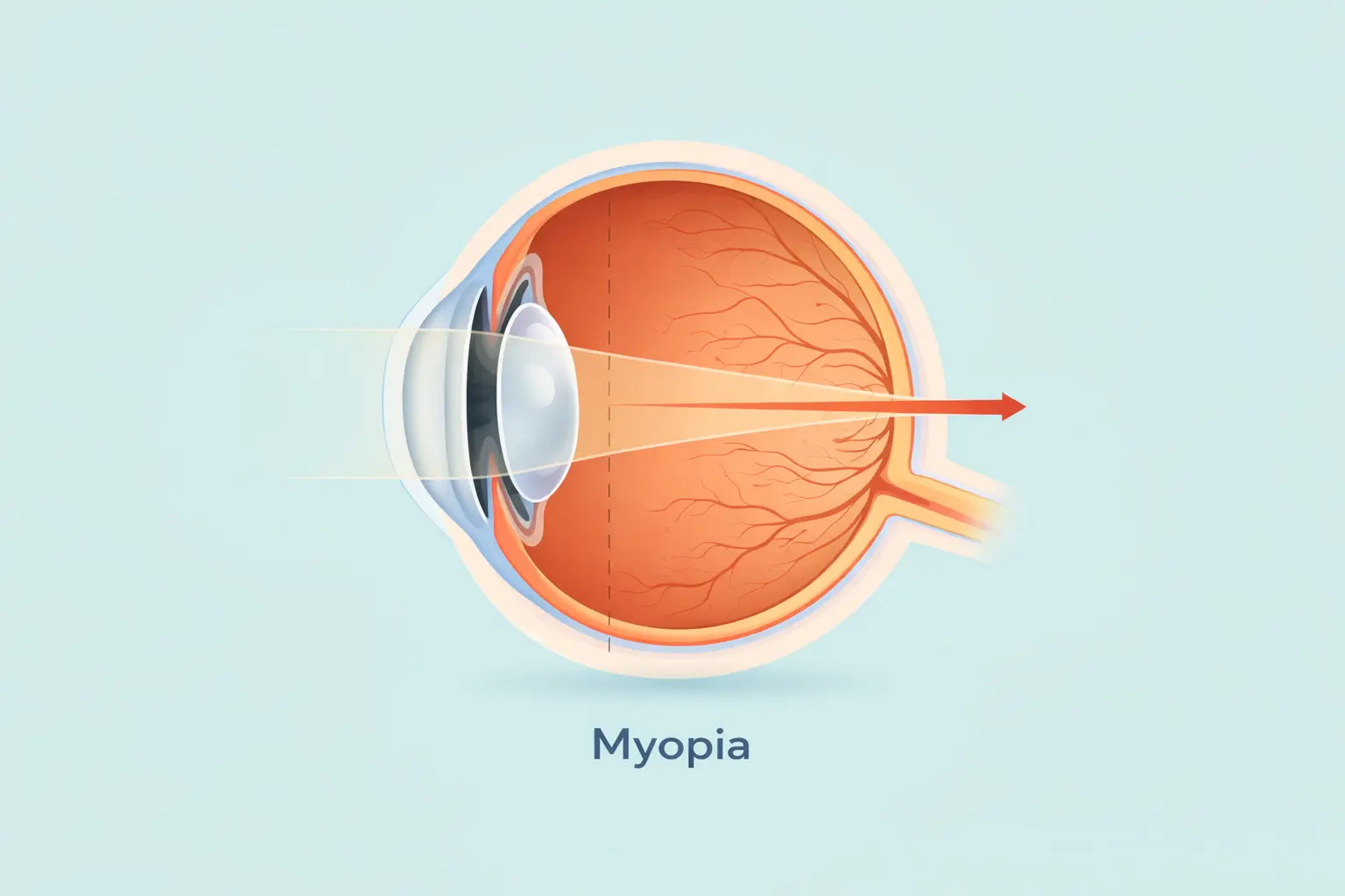 myopia